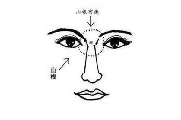 山根有痣的寓意